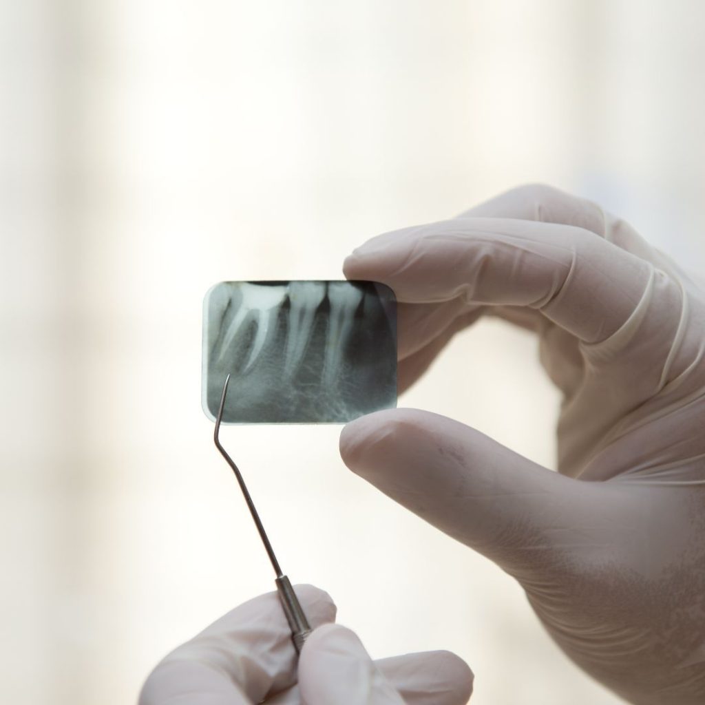 Devitalizzazione dente a Vicenza