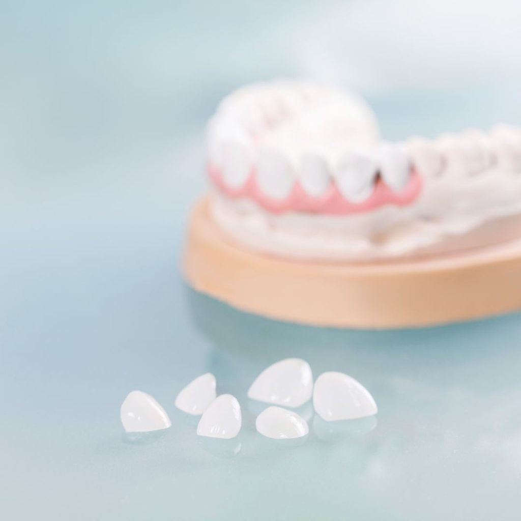 Faccette dentali a Vicenza