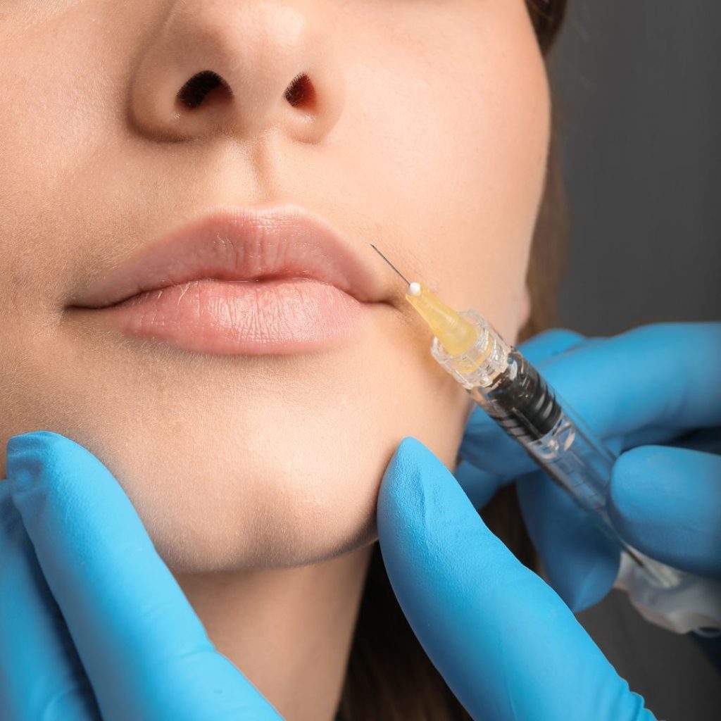 Filler labbra a Vicenza