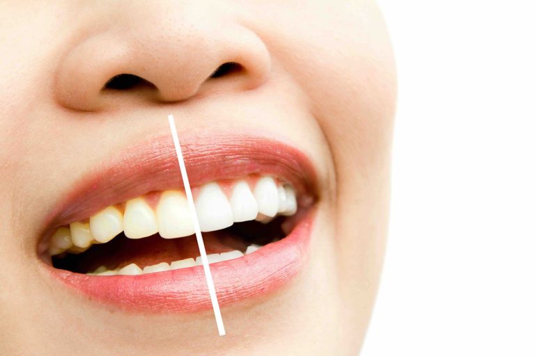 Come funziona lo sbiancamento denti